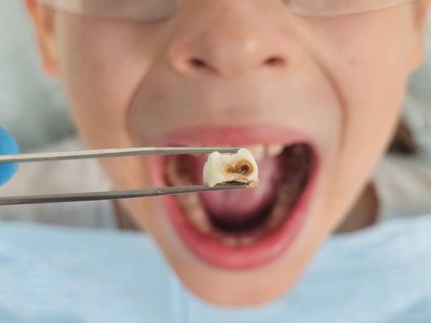 Best Emergency Tooth Extraction in Running Springs, CA